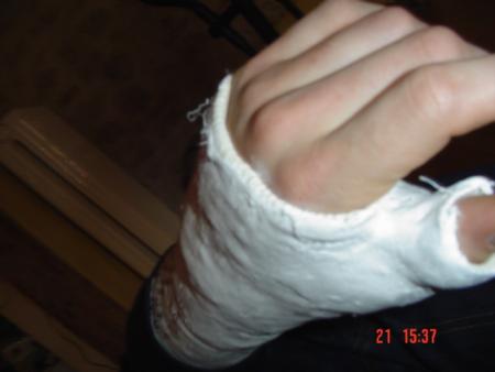 jme suis casser le scafoide
